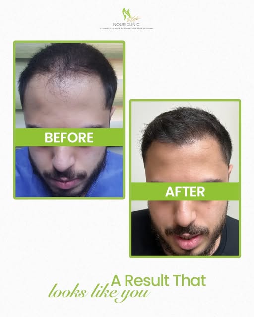 A natural result should feel like you
—not like a procedure.
Start your hair restoration journey
