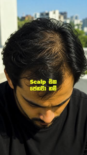 මේ ලක්ෂණ 3ක් ඔයාටත් පේනවද? 👀
Hairline එක ටික ටික පස්සට යනවා නම්, scalp එක කලින්ට වඩා පැහැදිලිව පේනව