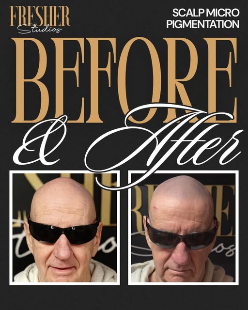 Age isn’t the deciding factor. Your goals are. 

Scalp Micropigmentation (SMP) can be a great option