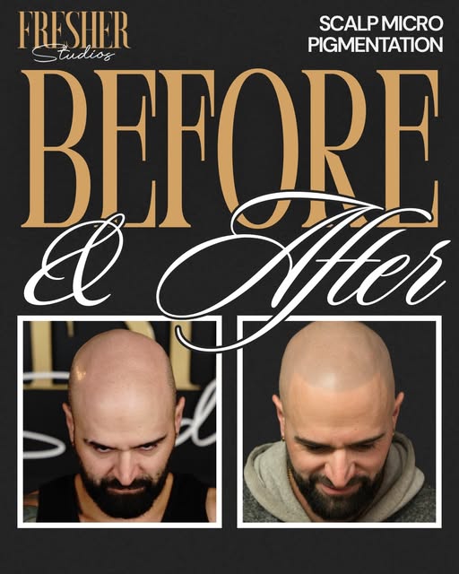 Healed results after a reset. 

This client came to me after laser removal to correct work from a pr