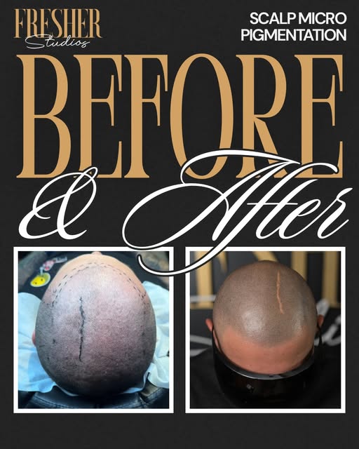Healed SMP, real-life detail. 

We intentionally kept the scar visible—because the goal is not a “pe