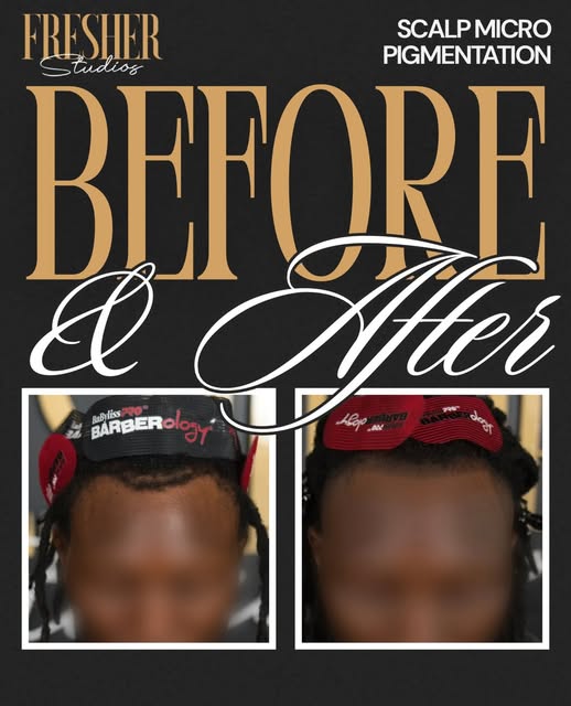 Traction alopecia is real—and it can be brutal on the hairline when dreads or braids are worn too ti