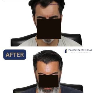 3,200 GRAFTS BY STRIP FUT.

This wonderful gentleman came to us looking for density in the temples a