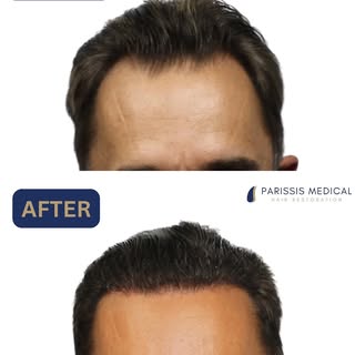 🙌 2,326 Grafts by FUT. 

This is a 6 month follow up result of a gentleman in his 50s who came to u