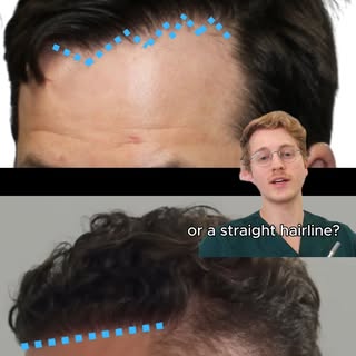 ❓Which looks more natural?

Thanks to @mrhairline1 for bringing awareness to the 'Zig Zag' hairline!
