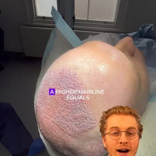 ⚠️ Higher Hairline = Higher Density. 

➡️ When the hairline is dropped too low, the patient commits 