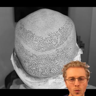 ❓Why have I left this long strip "untouched"?

➡️ For young patients with advanced hair loss, strip 