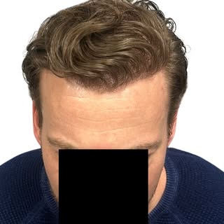 Recent Repair Case with @drblakebloxham 

➡️ We have made a video on this patient before, but I want