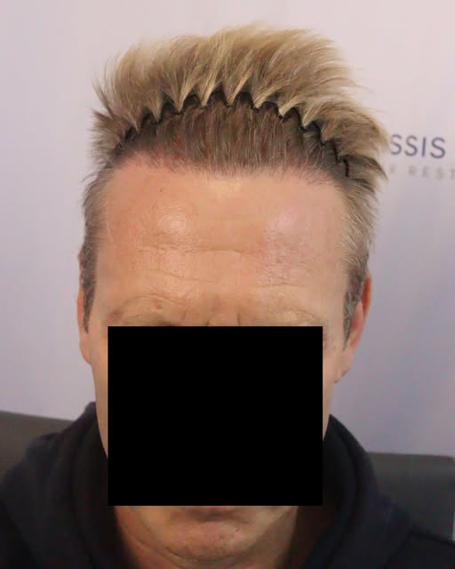 A Natural Hair Transplant Result.

➡️ This patient is 9 month after his 2400 graft procedure with us