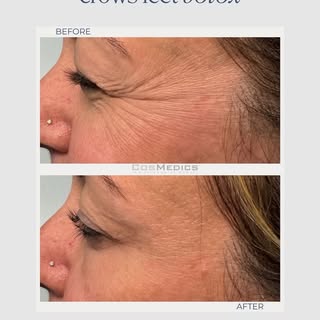 Summer is one of the biggest culprits when it comes to making crow’s feet look more noticeable☀️

Be