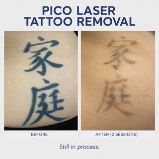 ✨ PICO LASER TATTOO REMOVAL ✨

The first photo is before treatment, and the second photo shows the t