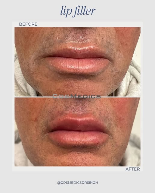 Yes — men get lip filler too.
This treatment was designed to subtly even out the lips and restore na