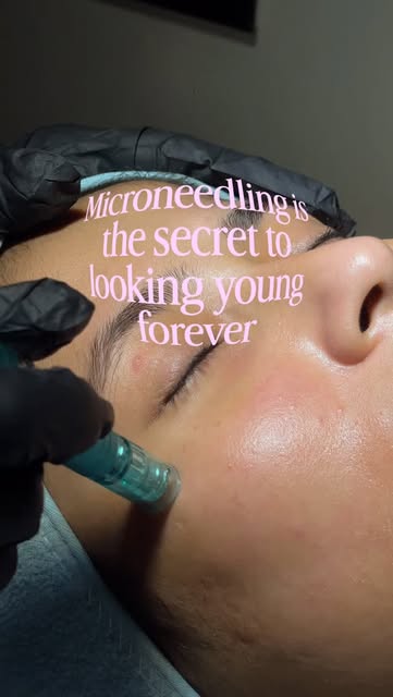 POV: you finally started investing in your skin🤌🏻✨

Microneedling helps stimulate collagen, improv