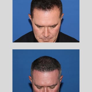 FUE hair transplant was performed to rebuild the patient’s hairline and restore the corners that had