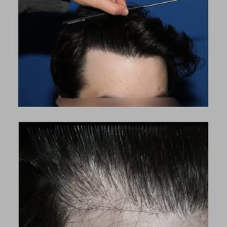 This patient in his mid-20s previously underwent an FUE hair transplant to the hairline at another c