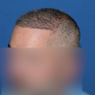 **Beard-to-Scalp Hair Transplant**

Beard hair can be a valuable donor source for select patients, e