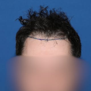 A common question during consultation is when a patient can return to work without any signs of surg