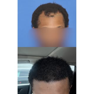 Afro-textured hair, with its tightly curled structure, is widely considered the most technically cha