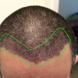 Not every hair transplant is performed because of hair loss. A subset of patients have minimal to no