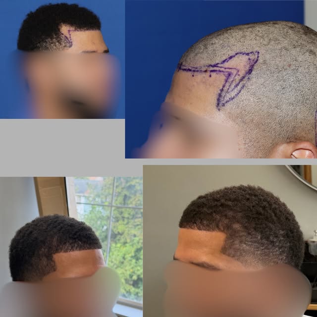 Patient with Afro-textured hair. Post-op photos shown 4.5 months after FUE hair transplant for deep 