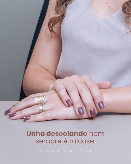 É muito comum olhar para uma unha descolando e pensar imediatamente em micose.

Mas unhas podem muda