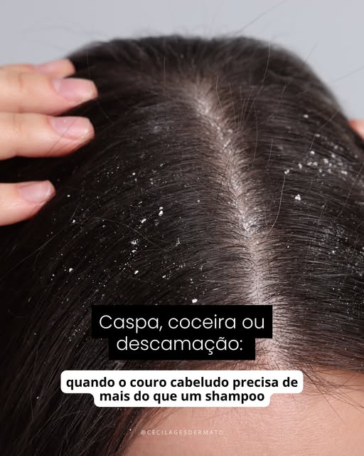 Nem toda descamação é “só caspa” e nem toda coceira vai melhorar com o shampoo que funcionou para ou