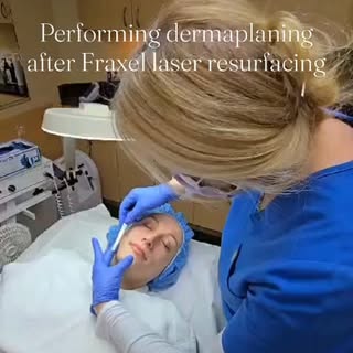 The perfect finishing touch after Fraxel ✨
At today’s follow-up visit, I performed gentle dermaplani