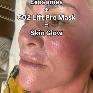 ✨ The glow is real—and it’s science. ✨
Microneedling + exosomes followed by a CO2Lift® Pro Mask is o