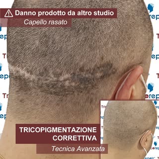 TRICOPIGMENTAZIONE CORRETTIVA su danno multiplo da Cicatrice Strip, Iperpigmentazione e Laser

Nel c