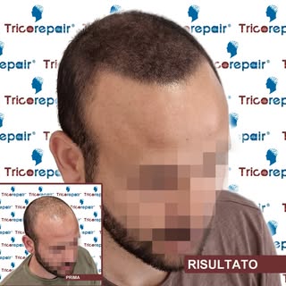🔹 TRICOPIGMENTAZIONE EFFETTO IBRIDO Esclusiva by TricoRepair
La soluzione ideale per coprire dirada