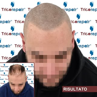 Tricopigmentazione Effetto Rasato – Anti Toppik

In questo caso si parte da una calvizie molto avanz