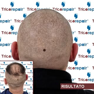 Tricopigmentazione Effetto Rasato – Anti Toppik (Vertice)

In questo caso si parte da una calvizie m