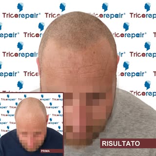 Tricopigmentazione Effetto Rasato su calvizie avanzata e capello castano chiaro - Vista frontale

Il