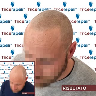 Tricopigmentazione Effetto Rasato su calvizie avanzata e capello castano chiaro - Vista laterale

Il