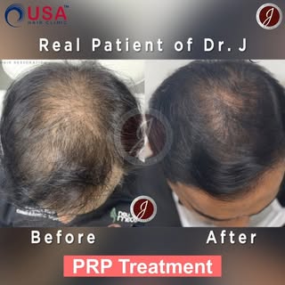 🤩😍Summer Special Offer....!🤩😍

👩‍⚕️ Looking for a non-surgical solution to boost hair growth? �