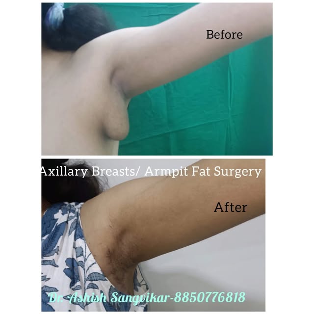 #axillarybreastremoval  #armpitfat #accessorybreasts #restoreclinicsnavimumbai #drashiahsangvikar