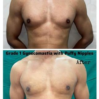 #gynecomastiabeforeandafter #gynecomastiasurgery #menboobs #menchestreduction #drashishsangvikar