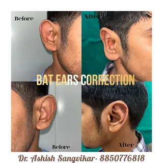 #batear #prominentears #congenitaleardeformity  #earreshaping #drashishsangvikar