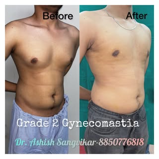 This is result immediately after removal of dressing on 5th  post operative day. Note that the muscu
