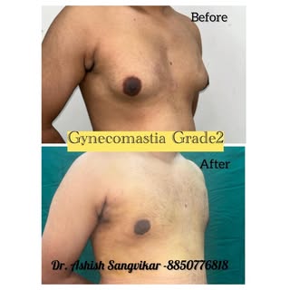 #gynecomastiasurgery #menboobs #malechestreduction  #drashishsangvikar #restoreclinicsnavimumbai 

#