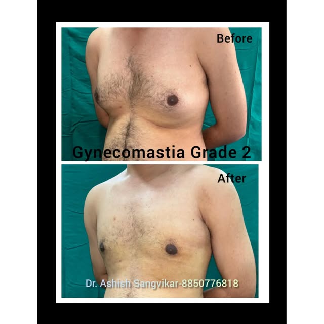 #gynecomastia #gynecomastiatreatment #malechestreduction #drashishsangvikar #gynecomastiasurgery