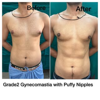 Puffy or prominent nipples are small grade Gynecomastia with mostly breast gland with minimum fat. T
