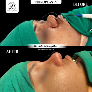 #rhinoplasty #nosereshaping #rhinoplastymumbai #rhinoplastybeforeandafter #drashishsangvikar