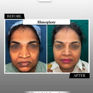 #rhinoplasty #nosereshapingsurgery #rhinoplastymumbai #nosejobbeforeandafter #drashishsangvikar