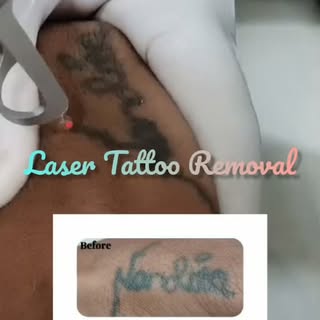 #tattooremovalspecialists #lasertattoremoval #lasertattooremovalnavimumbai #tattooremovalbeforeandaf