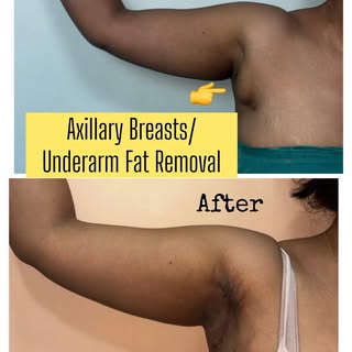 Axillary Breasts , also known as Underarm fat pads or Armpit fat are lumps seen in underarm areas of
