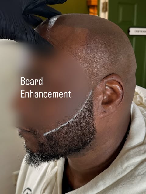 Happy World Beard Day. 

Did his scalp over a year ago, he came back for a permanent beard enhanceme