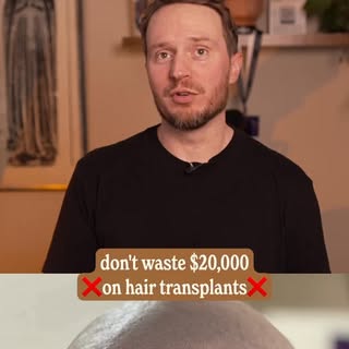 Twenty grand and a year of waiting, and the hairline still didn’t come in right. It happens more tha