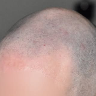 Scalp micropigmentation in Bristol PA. 

Natural faded hairline. Freshly done, redness subsides in 2