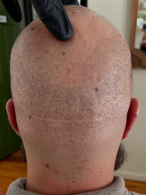 Healed FUT scar. 

We don’t over saturate to hide the scar, we blend it so it stops pulling focus. B